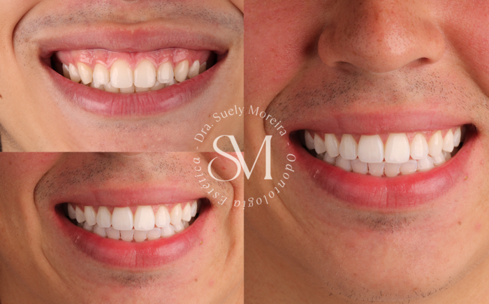 Clareamento-Dental-2