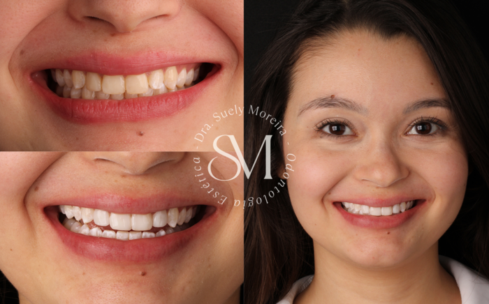 Clareamento-Dental