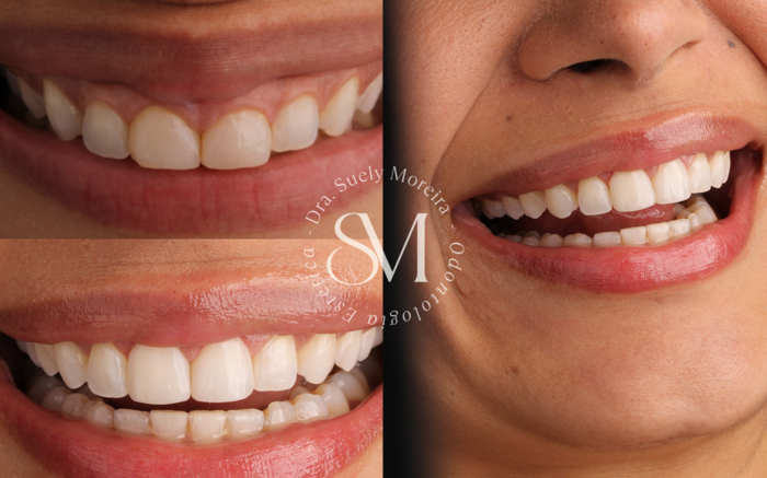 Gengivoplastia